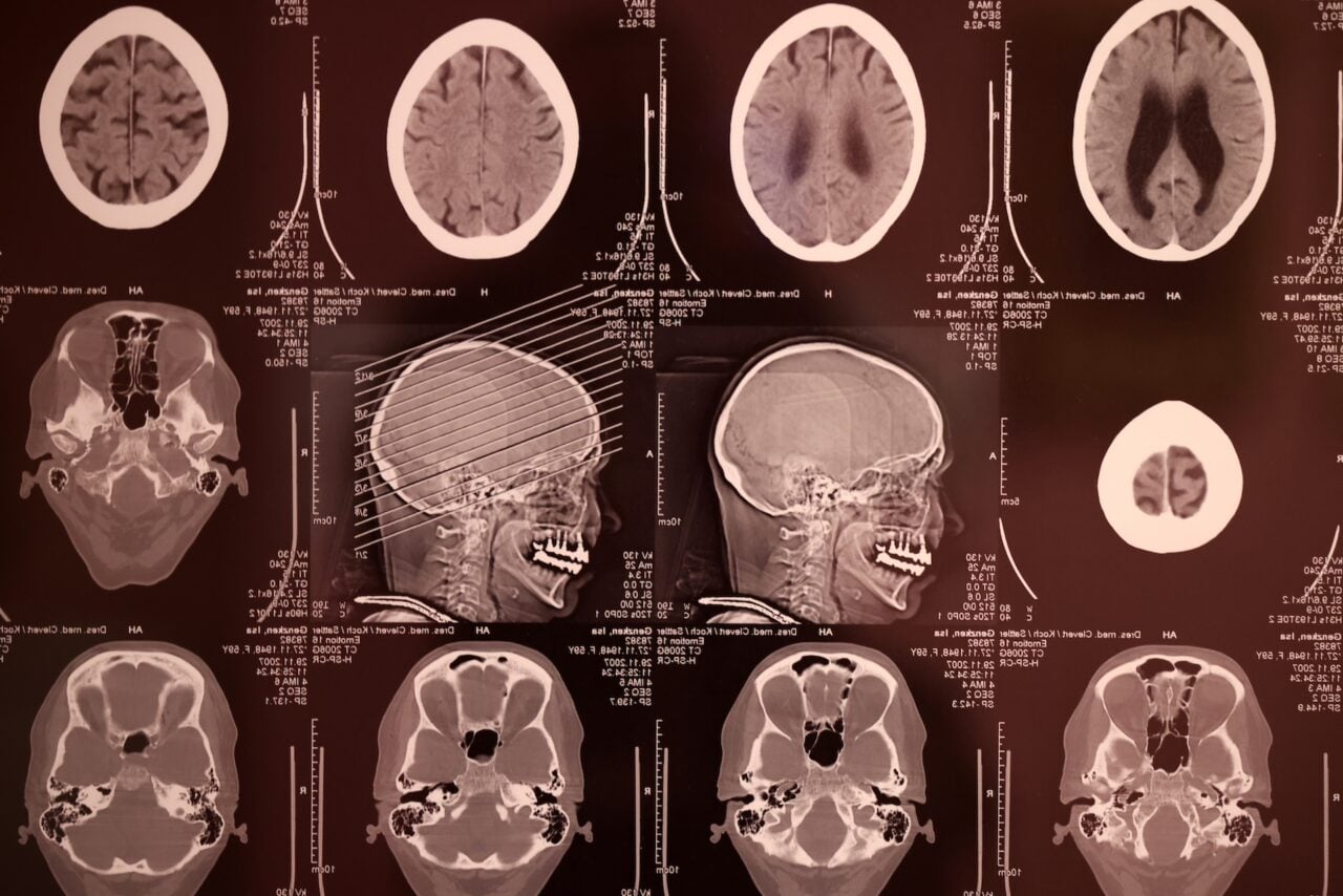 AI is helping scientists decode noisy brain activity into natural language.