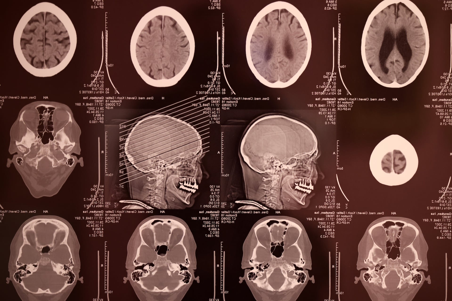AI is helping scientists decode noisy brain activity into natural language.