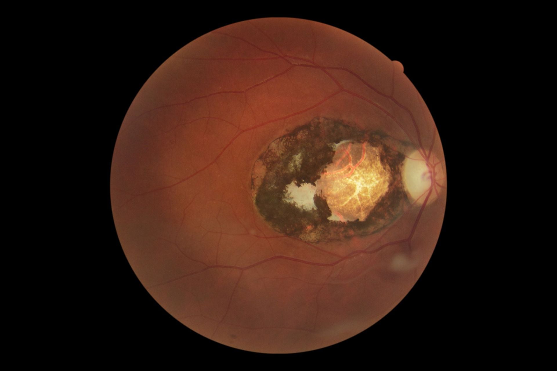 An example of retinal scarring caused by congenital toxoplasmosis.