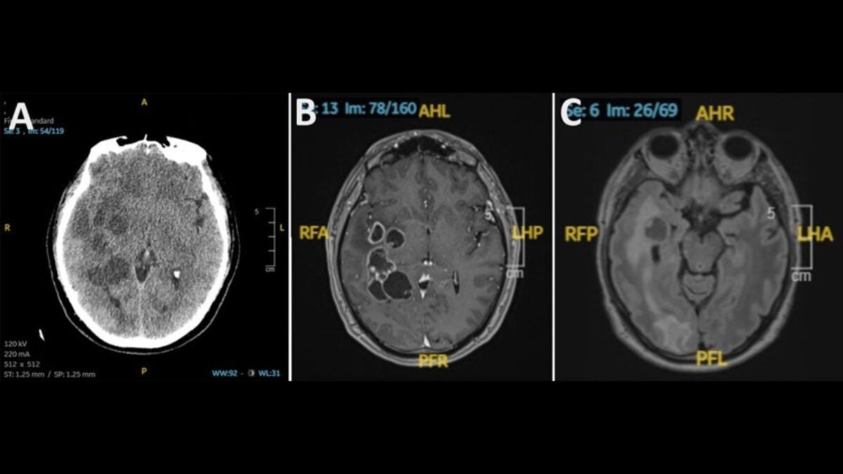 Man’s Suspected Brain Cancer Turns Out to Be Something Much Creepier
