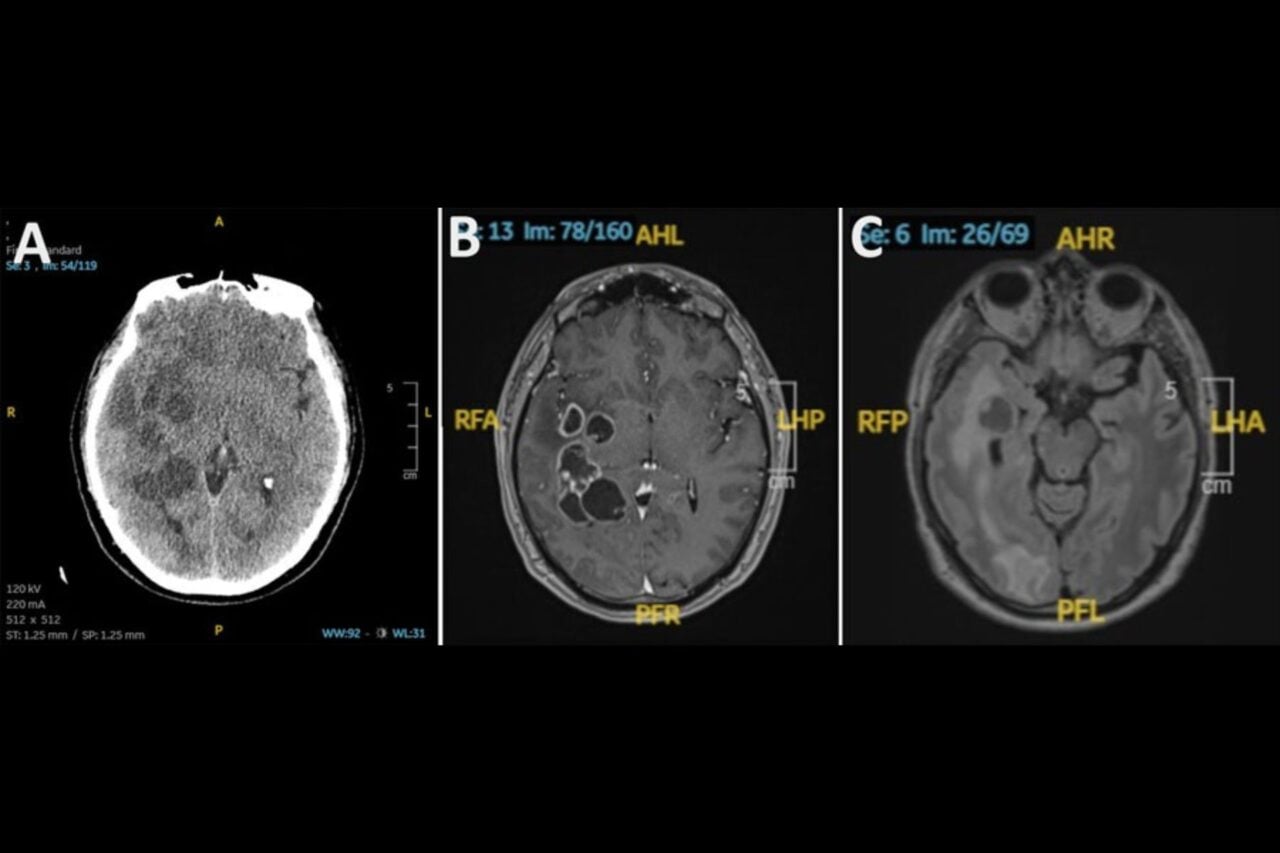 Man’s Suspected Brain Cancer Turns Out to Be Something Much Creepier