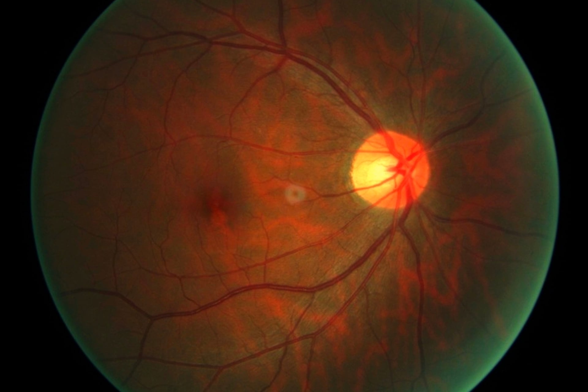 Life Biosciences’s goal in these first clinical trials is to regenerate aging neurons in the optic nerves of patients struggling with glaucoma