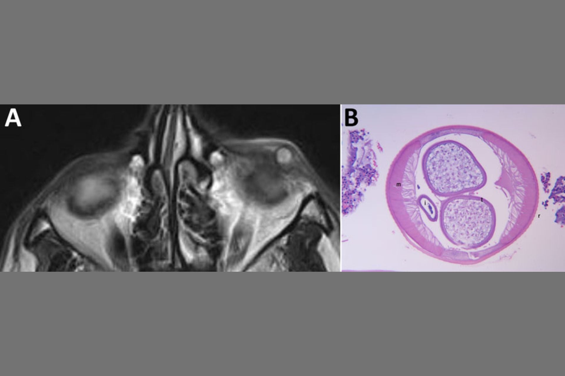 Image A shows the MRI scan that identified a cyst in the man's eyelid; image B shows a cross-section of the parasite removed from the man's eyelid.