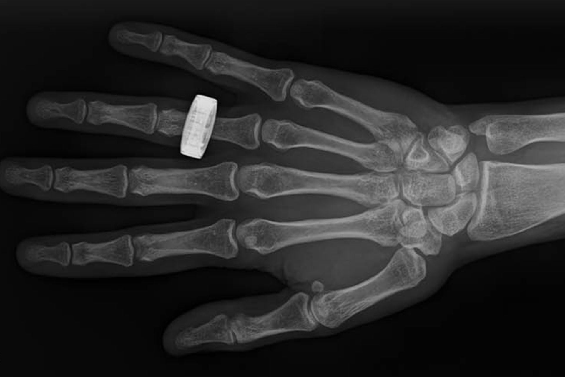 This hand radiograph was taken aboard SpaceX's Fram-2 mission, which launched on March 31, 2025.