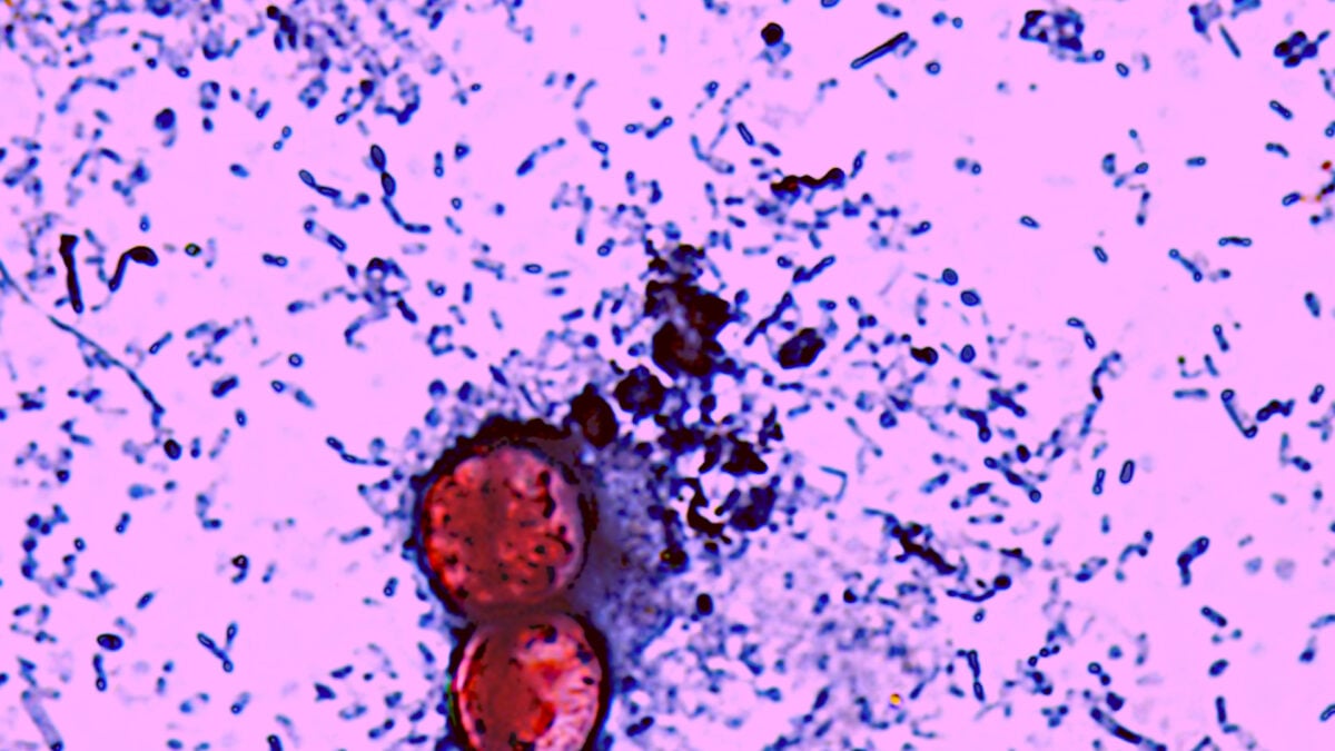 Things Are Getting Messier With the Explosive Diarrhea Parasite, as Officials Chase Down Multiple Outbreaks