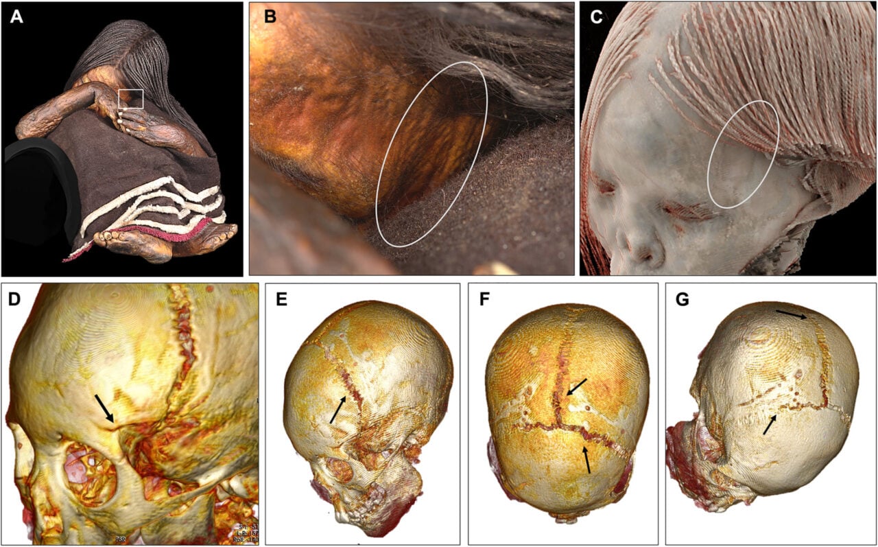 El Plomo Boy Cranial Injury Ct