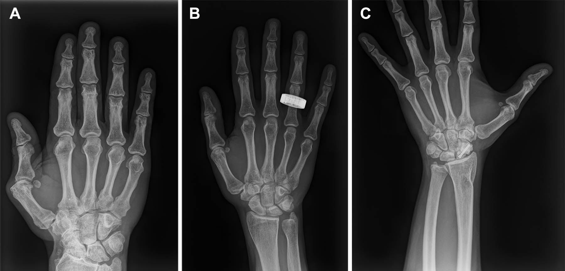 Pre Flight, In Flight, And Post Flight Hand X Rays