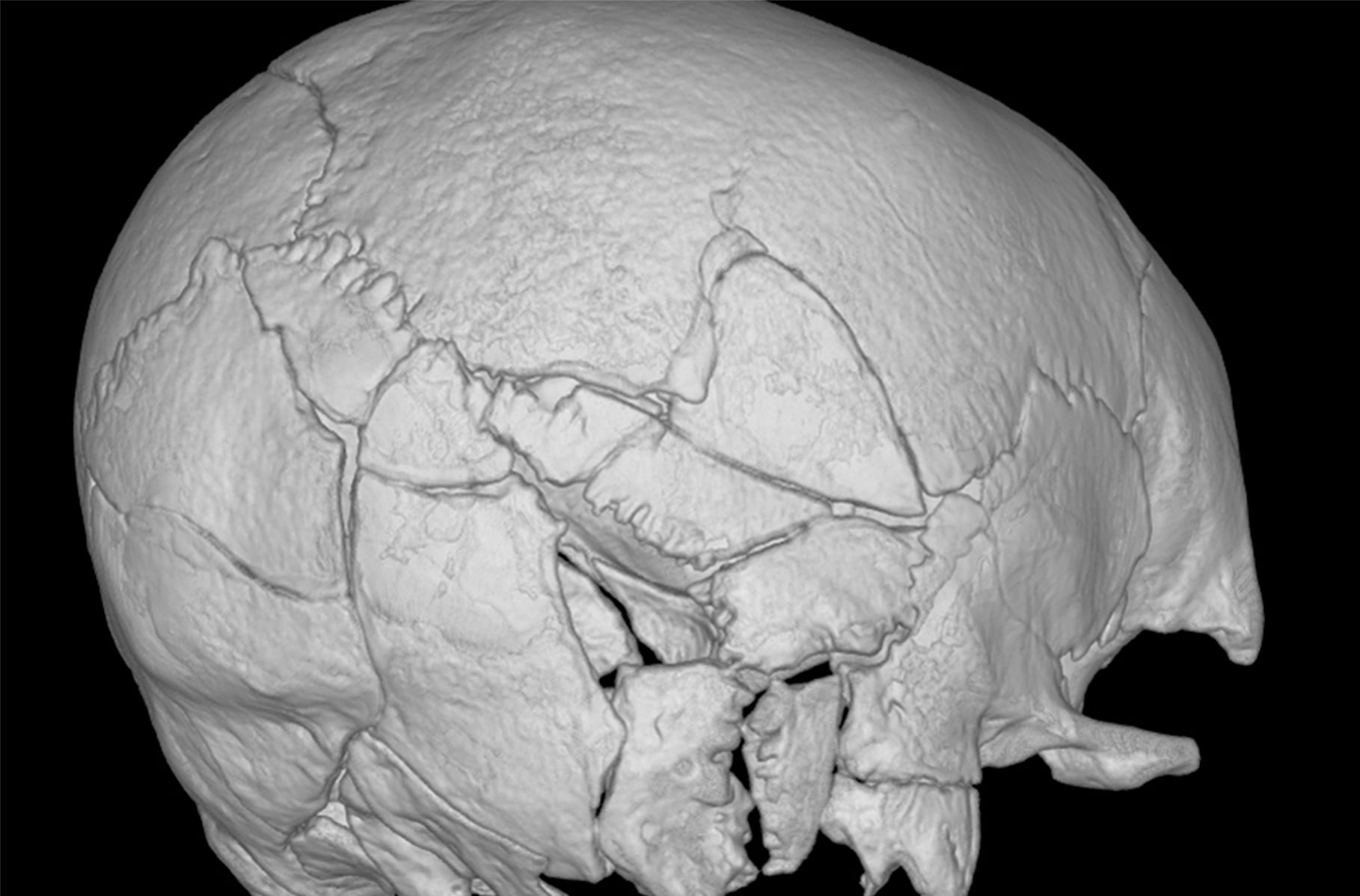 Stirling Castle Skeleton 150 Skull fractures