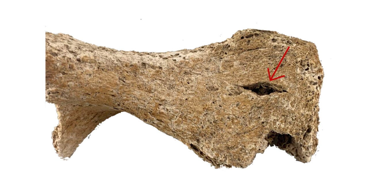 Pelvic Bone Simmering Mass Grave