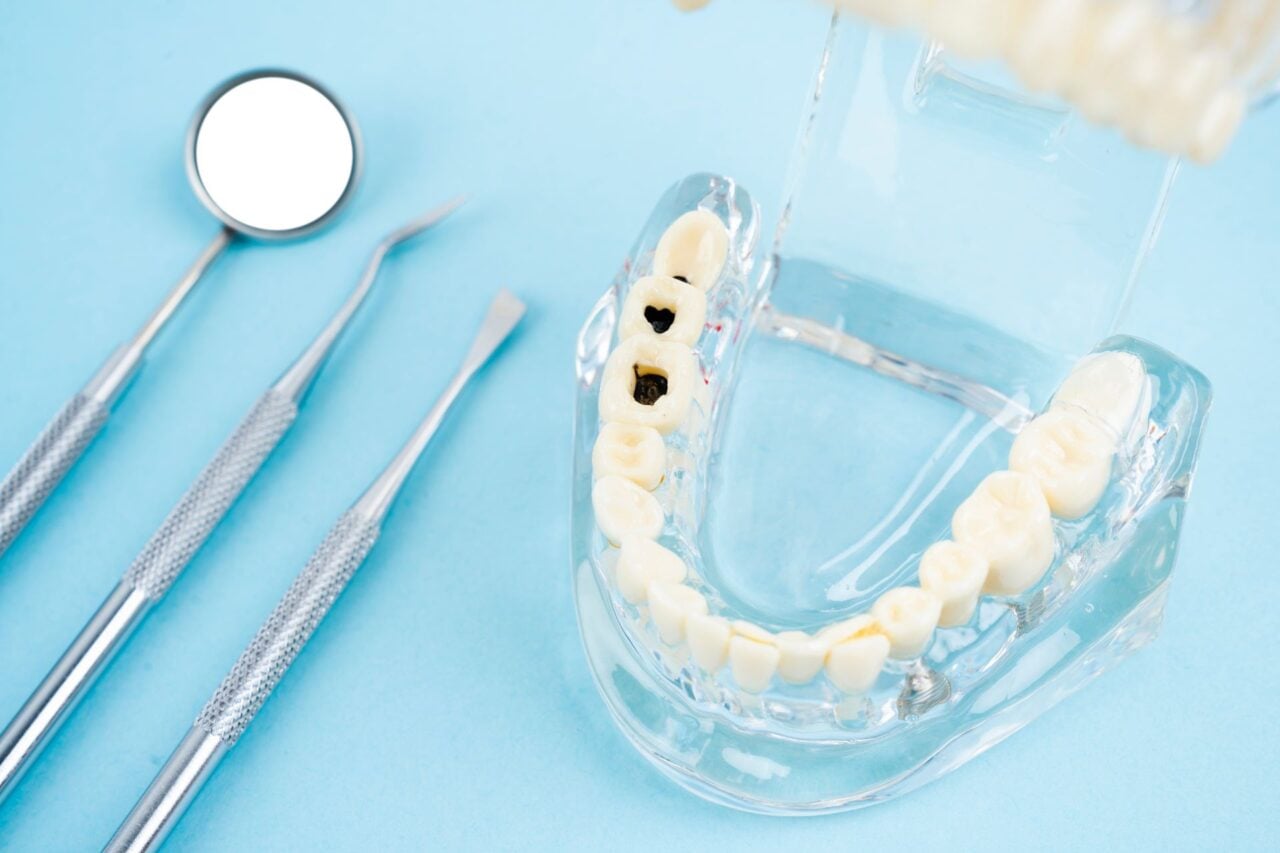 Liquid Fluoride Can Stop Cavities Without Drilling, Major Trial Finds