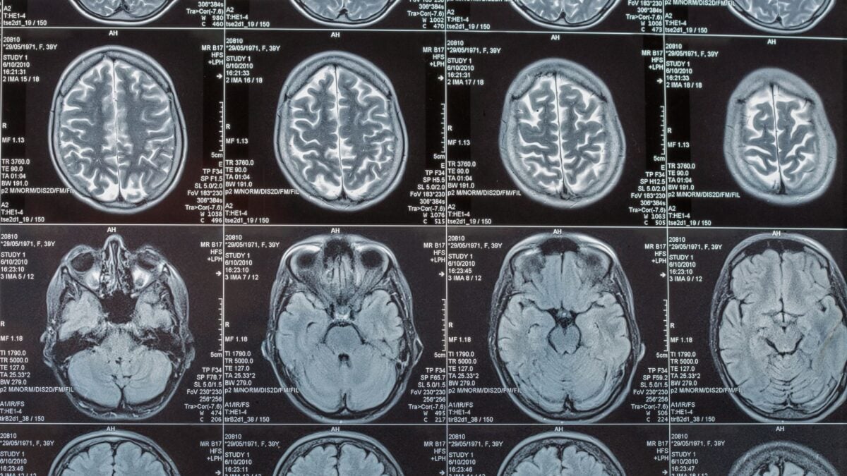 Scientists Say a Key Trigger for Alzheimer’s Damage Isn’t Even in the Brain