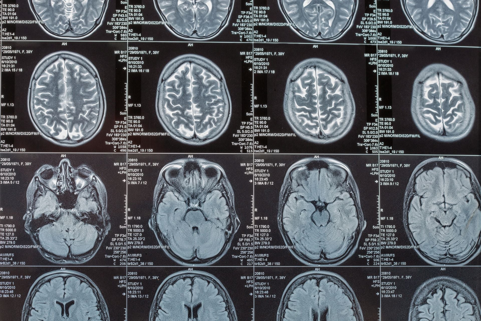 MRI images of a brain.