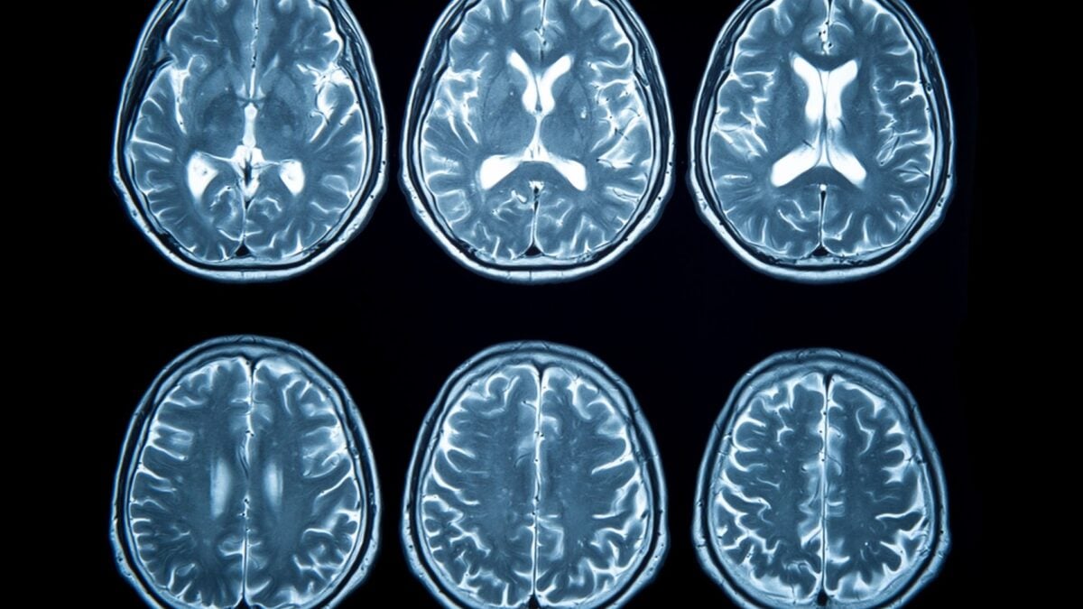 Stroke Rates in Younger Americans Have Nearly Doubled Since the 90s—and Scientists Can’t Fully Explain It