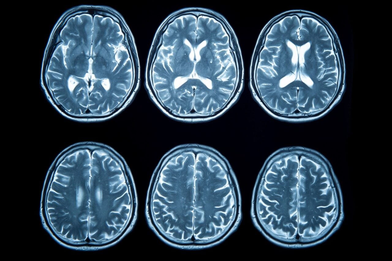 Mri Brain Scans