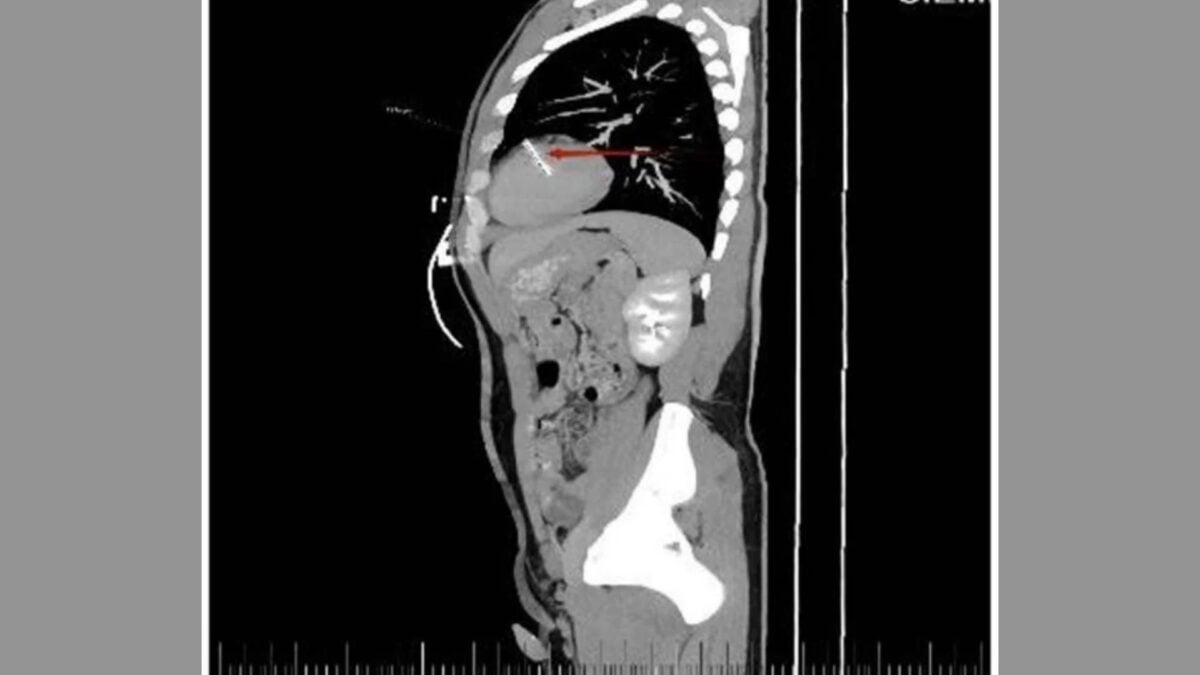 Doctors Scanned This Man’s Chest and Found a Sewing Needle in His Heart