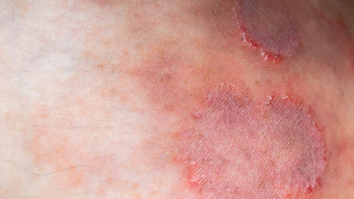 A Drug-Resistant Ringworm Fungus is Surging Across the Globe, Scientists Warn