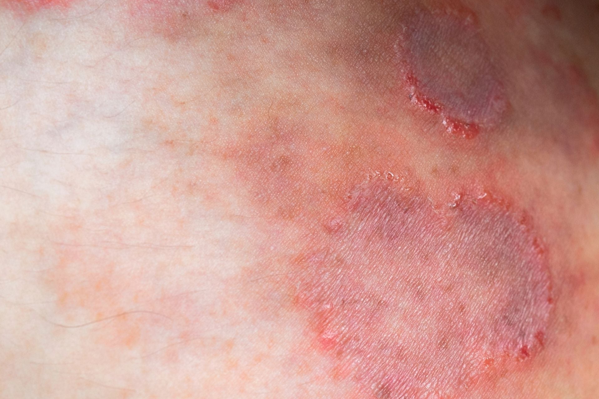 An example of ringworm infection.