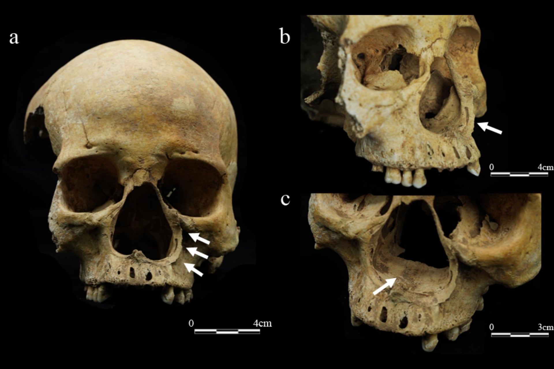 The facial skeleton of a woman whose nose appears to have been severed.