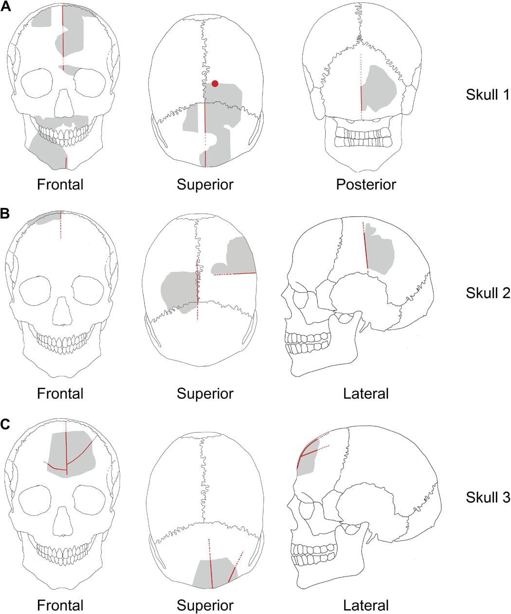 Gobekli Tepe Skull Artificial Modifications