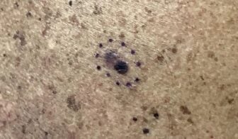 Melanoma Lesion