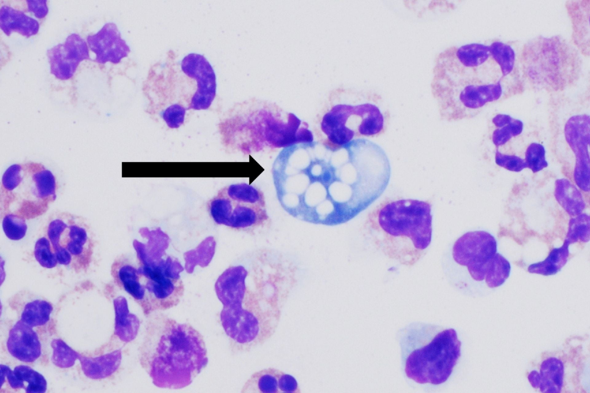 Naegleria fowleri seen under a microscope.
