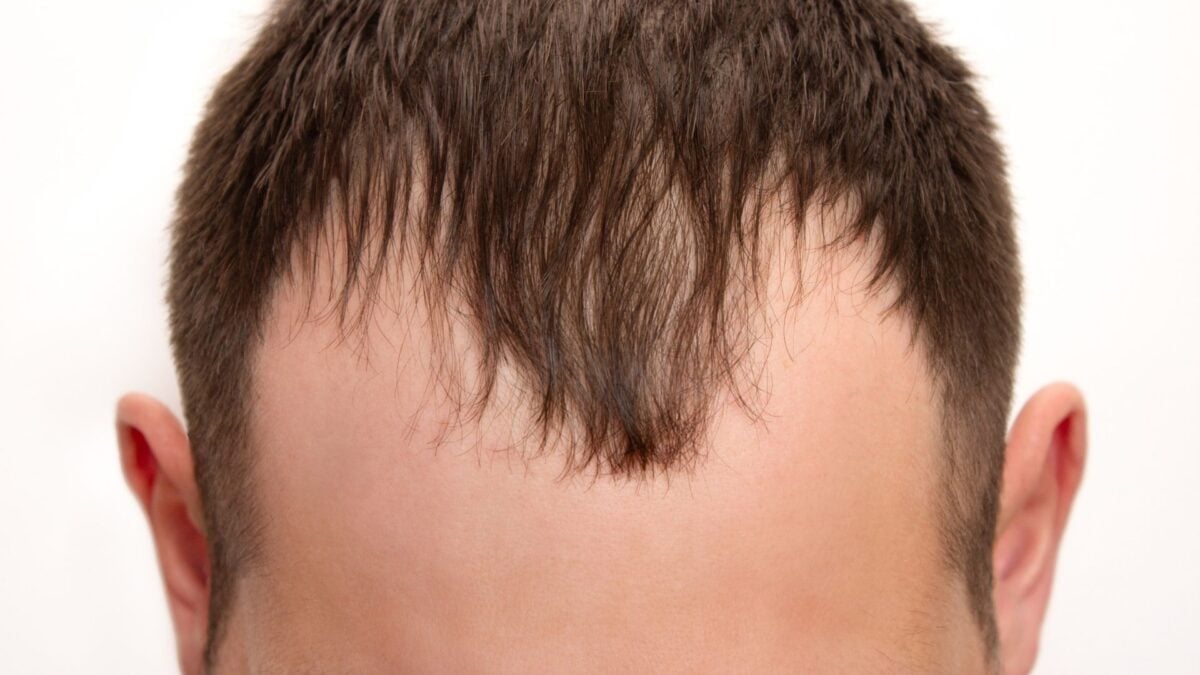 Balding Men Haven’t Had a New Pill Since the 1990s.…