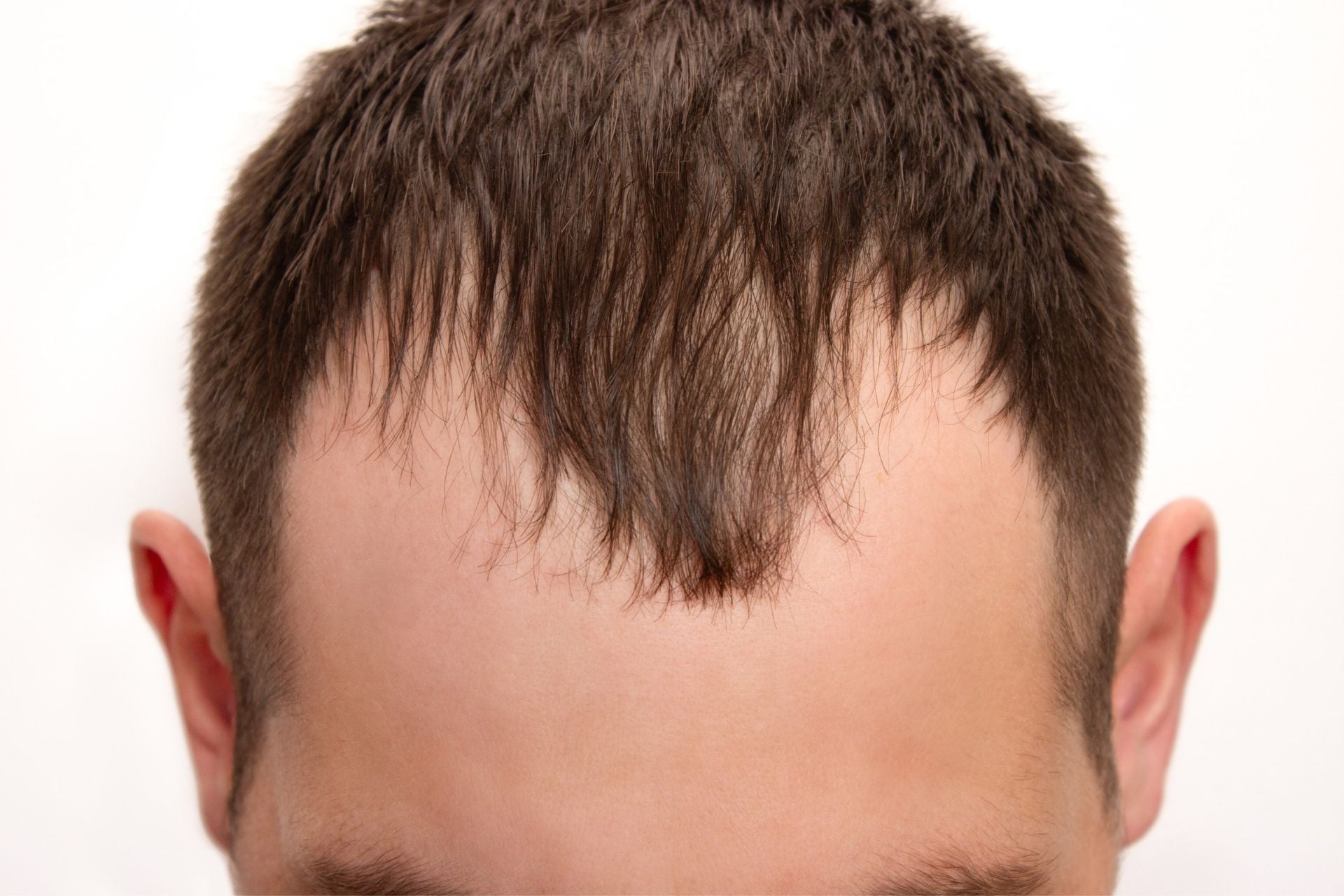 A man with a receding hairline.