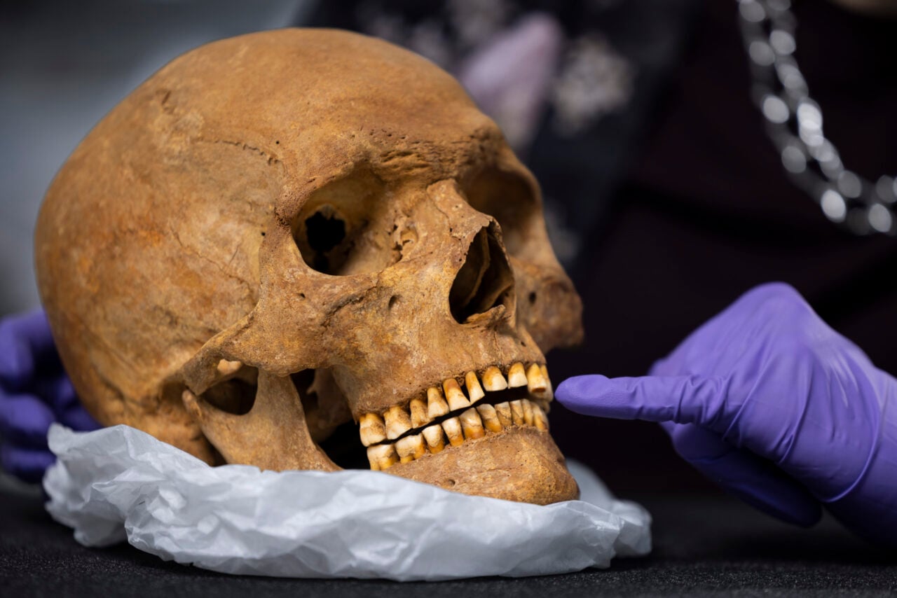 Researcher Examines Skull Of Man From Roman Scotland
